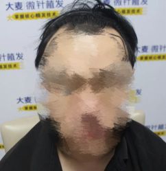 -大麦微针植发丨全国连锁