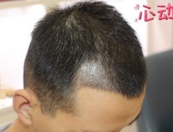 -大麦微针植发丨全国连锁