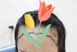点击看大图 -大麦微针植发全国连锁