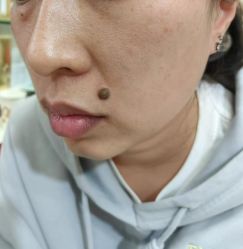 -北京美痣堂古方祛痣斑疣瘊