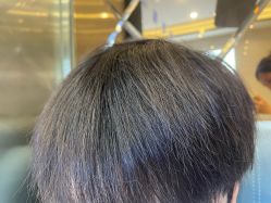 -碧莲盛·不剃发植发