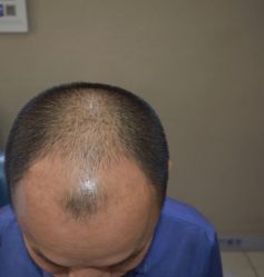 -大麦微针植发全国连锁