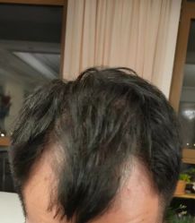 点击看大图 -大麦微针植发丨全国连锁