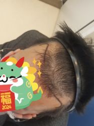 -大麦微针植发丨全国连锁