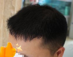 -大麦微针植发丨全国连锁