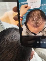 -碧莲盛·不剃发植发