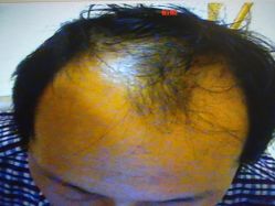 点击看大图 -大麦微针植发丨全国连锁