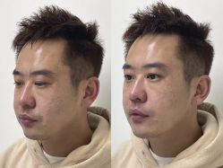 体验前-CMS西美斯·美式医疗美容