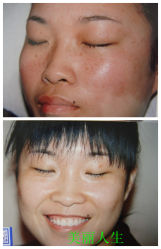 -美丽人生祛斑扁平疣汗管瘤中心