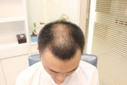 点击看大图 -大麦微针植发丨全国连锁