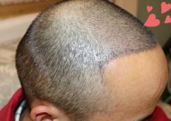 -大麦微针植发丨全国连锁