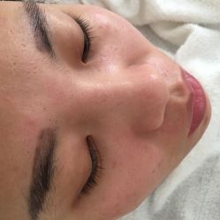 -苗方清颜专业祛痘
