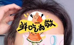 -大麦微针植发全国连锁