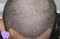 -大麦微针植发丨全国连锁