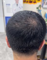 -碧莲盛·不剃发植发