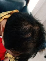 -碧莲盛·不剃发植发