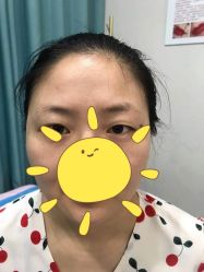 体验前-郡艺医疗美容·微整·眼鼻吸脂