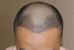 -大麦微针植发全国连锁