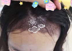 -大麦微针植发全国连锁