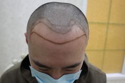 -大麦微针植发丨全国连锁