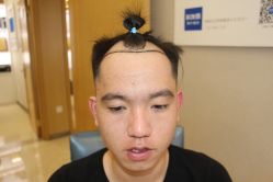 -大麦微针植发丨全国连锁