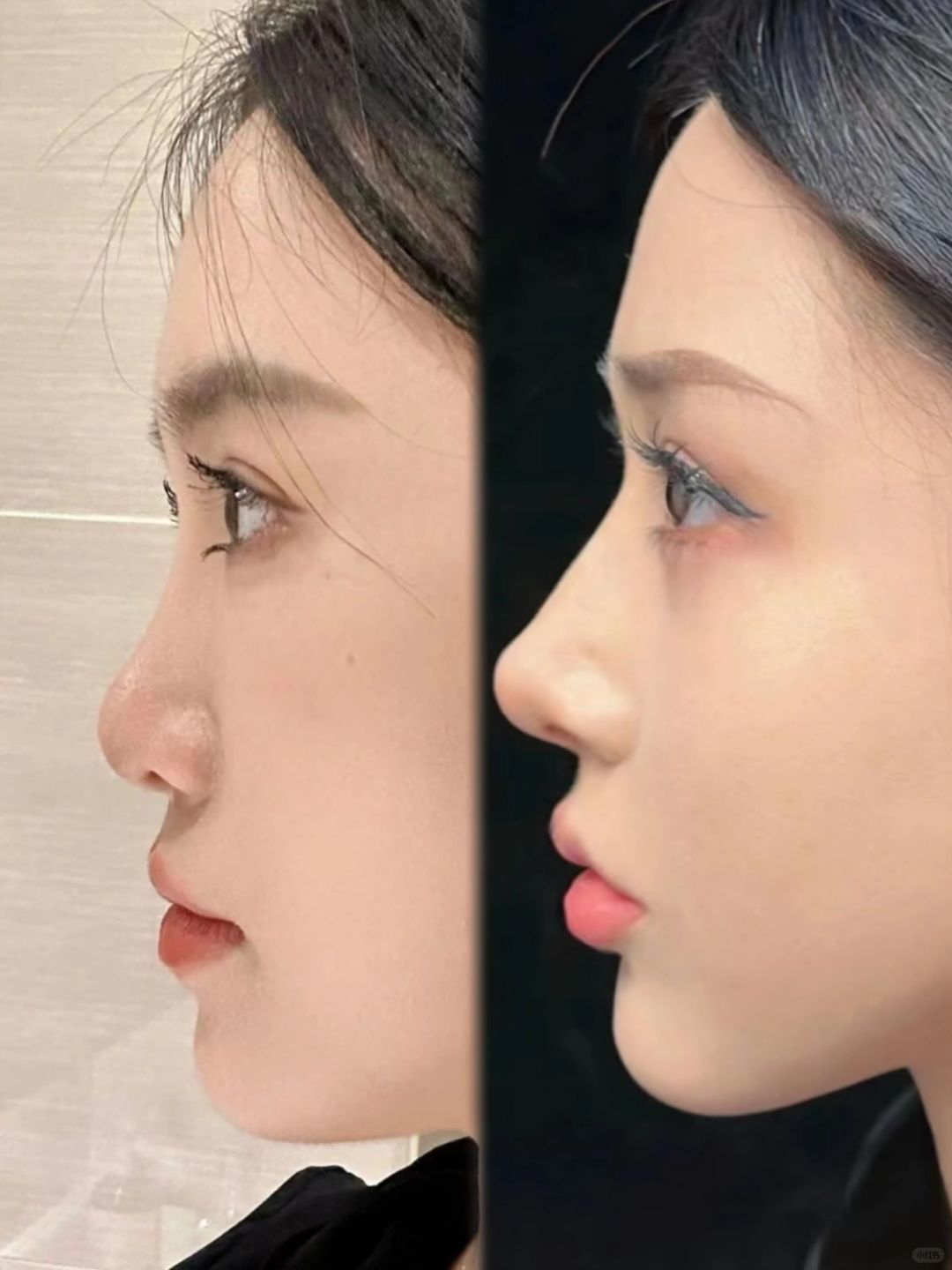 你就说这鼻子这侧脸,是不是do完更好看吧