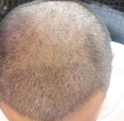 -大麦微针植发全国连锁