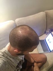 -大麦微针植发丨全国连锁