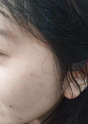 -北京美痣堂古方祛痣斑疣瘊