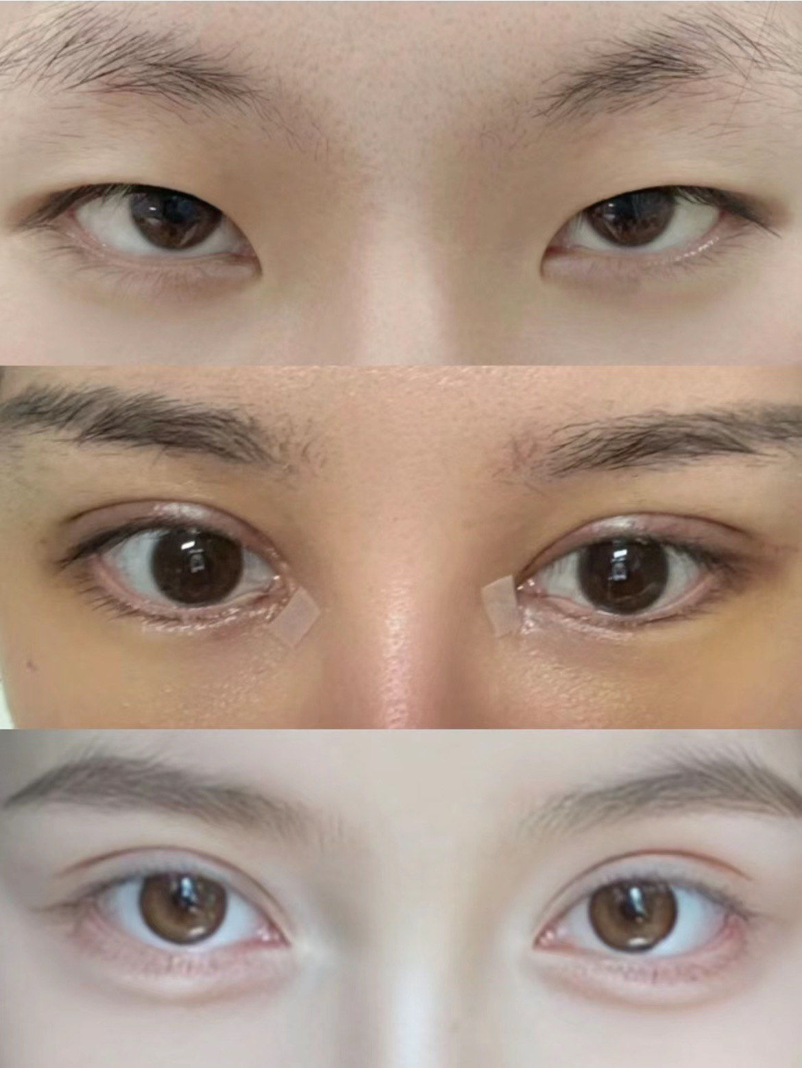 割双眼皮前后对比
