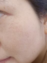 体验后-杭州米兰柏羽医疗美容医院