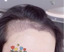 点击看大图 -大麦微针植发全国连锁