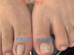 -朋朋修脚·灰指甲·甲沟炎·跖疣(人民路店)