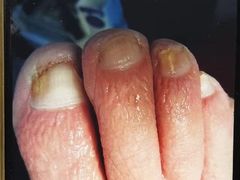 -世龙世家灰指甲鸡眼脚气甲沟炎跖疣护理(通州店)