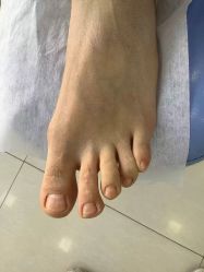 -德哥灰指甲脚气甲沟炎跖疣护理