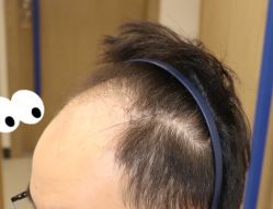 -大麦微针植发全国连锁