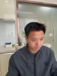 -大麦微针植发丨全国连锁