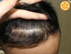 -大麦微针植发丨全国连锁