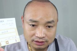 -大麦微针植发丨全国连锁