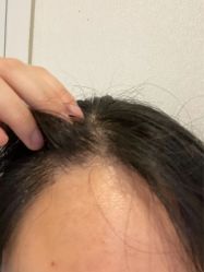 -大麦微针植发丨全国连锁