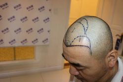 -大麦微针植发丨全国连锁