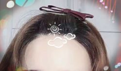 -大麦微针植发全国连锁