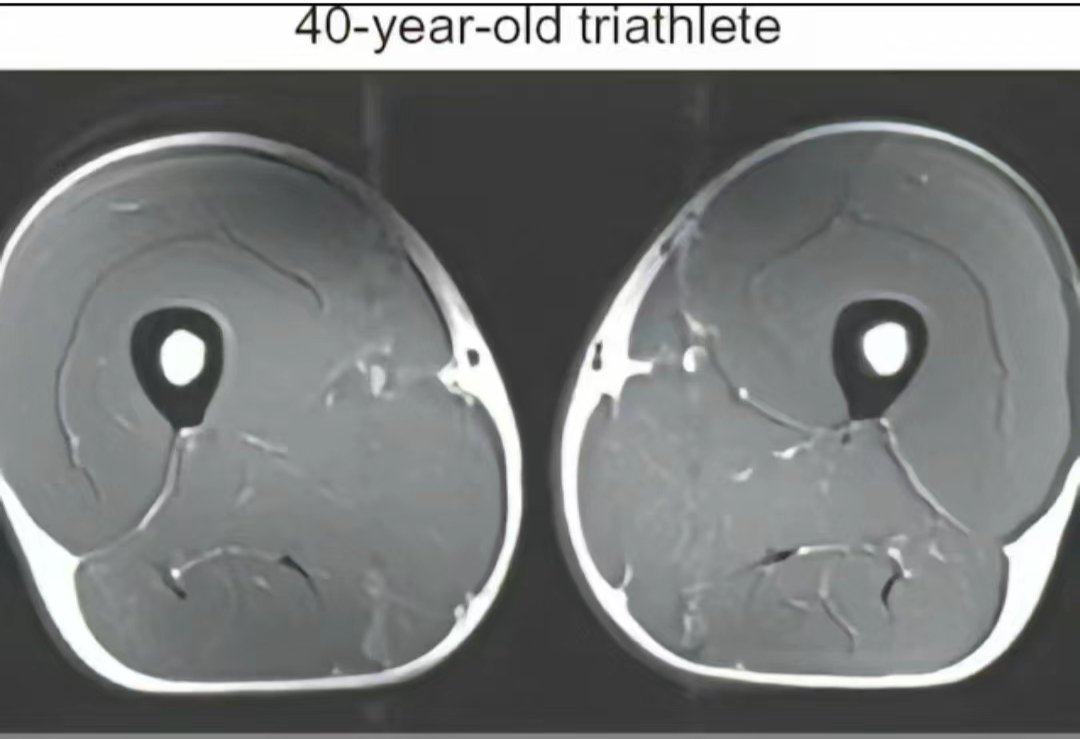 运动员的大腿的核磁共振图