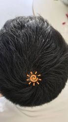 -大麦微针植发丨全国连锁