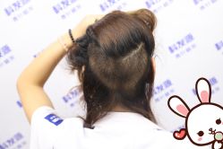 点击看大图 -大麦微针植发丨全国连锁