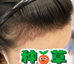 -大麦微针植发丨全国连锁