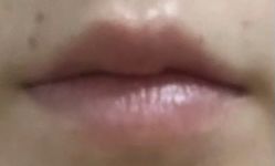 体验前-美莱医学美容医院