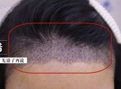 -大麦微针植发全国连锁