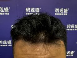 -碧莲盛·不剃发植发