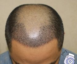 -大麦微针植发丨全国连锁